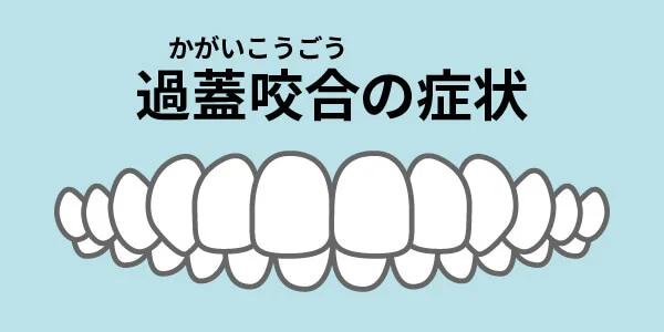 過蓋咬合　症状