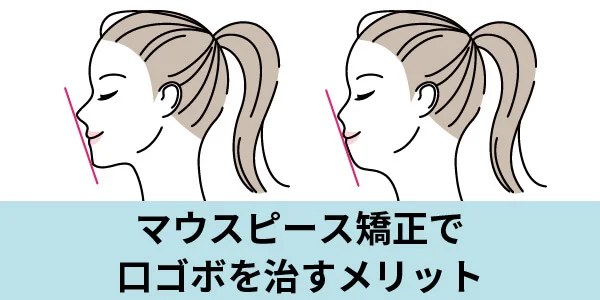 口コボ　マウスピース矯正