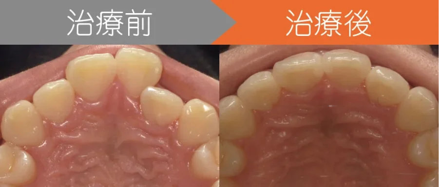 image-1 | ルーチェマウスピース矯正歯科 前歯のクロスバイトでお悩みの方をインビザラインで治療した例