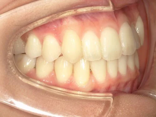 0009 | ルーチェマウスピース矯正歯科 治療後前歯下顎