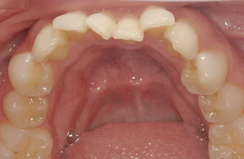 01-00-2 | ルーチェマウスピース矯正歯科 治療前右側