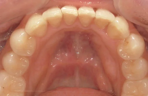 01-01-2 | ルーチェマウスピース矯正歯科 治療後右側