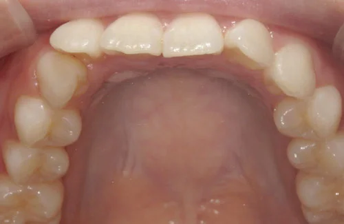 02-01-3 | ルーチェマウスピース矯正歯科 治療前右側