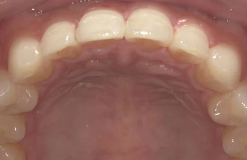 02-01-4 | ルーチェマウスピース矯正歯科 治療後