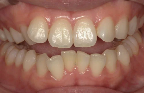 03-00 | ルーチェマウスピース矯正歯科 治療前右側