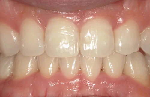 03-01-1-1 | ルーチェマウスピース矯正歯科 治療後上の歯がきれいに揃いました