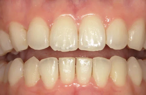 03-01 | ルーチェマウスピース矯正歯科 治療後右側