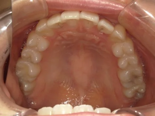 1-02 | ルーチェマウスピース矯正歯科 治療後前歯