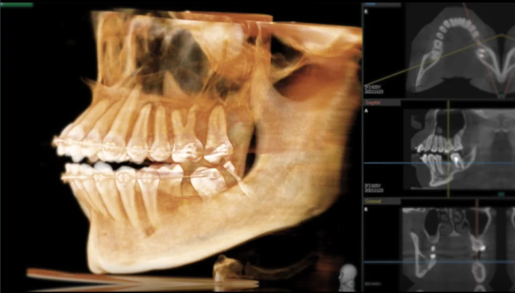 1 | ルーチェマウスピース矯正歯科 CTによる精密な歯列設計