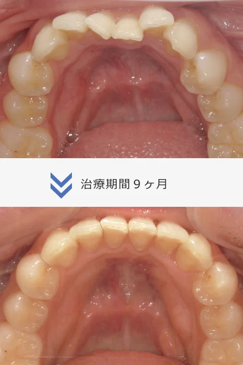 18 | ルーチェマウスピース矯正歯科 26枚コース/Invisalign モデレート
約6ヶ月〜9ヶ月
治療費 66万円