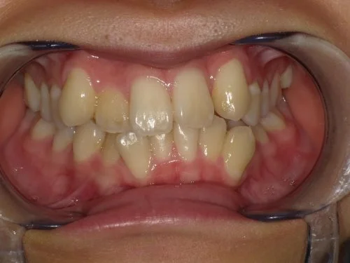 2-01 | ルーチェマウスピース矯正歯科 治療前前歯上顎