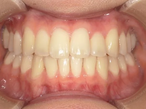 2-02 | ルーチェマウスピース矯正歯科 治療後前歯上顎側