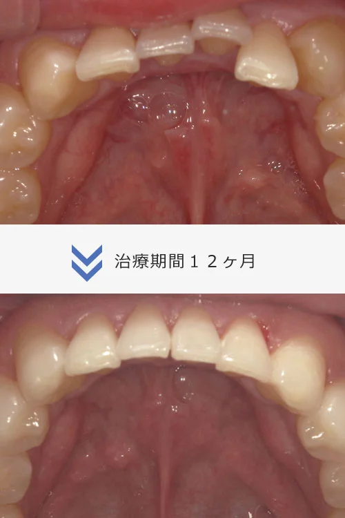 24 | ルーチェマウスピース矯正歯科 Invisalign フル1プラン
9ヶ月〜1年3ヶ月
治療費 88万円