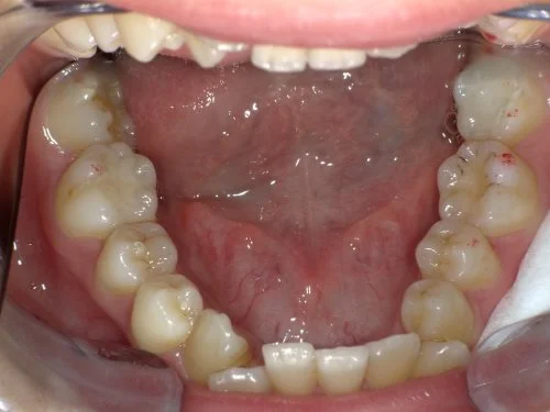 3-01 | ルーチェマウスピース矯正歯科 治療前前歯下顎