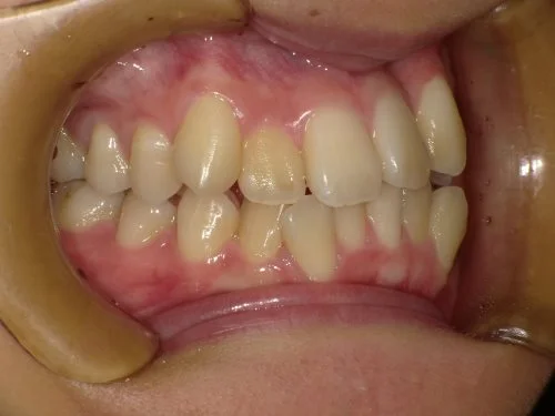 4-01 | ルーチェマウスピース矯正歯科 治療前左側