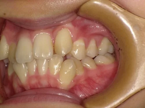 5-01 | ルーチェマウスピース矯正歯科 治療前右側