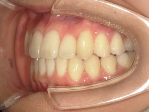 5-02 | ルーチェマウスピース矯正歯科 治療後右側