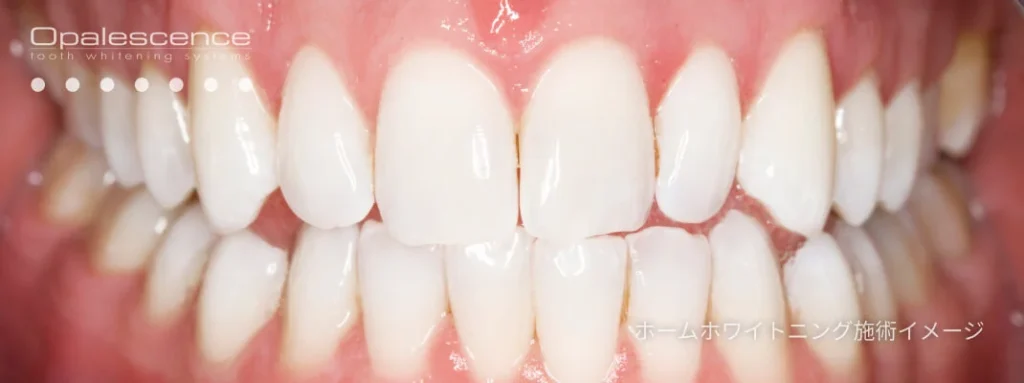 after | ルーチェマウスピース矯正歯科 医療ホワイトニングとは?
