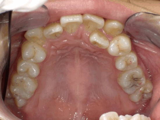 autoNakawariRender_1-02 | ルーチェマウスピース矯正歯科 <症例7>歯がガタガタで噛み合わせが悪くお悩み