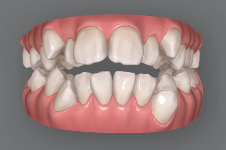 before-768x511 | ルーチェマウスピース矯正歯科 3Dシミュレーション