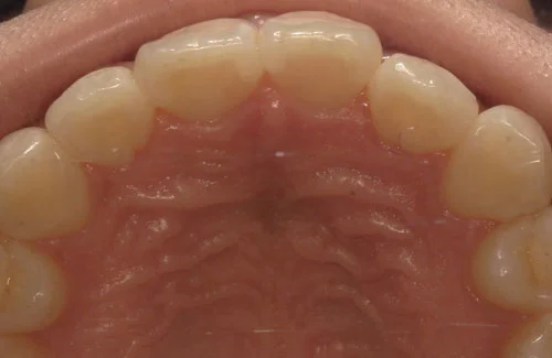 c4-1b | ルーチェマウスピース矯正歯科 治療後上の歯