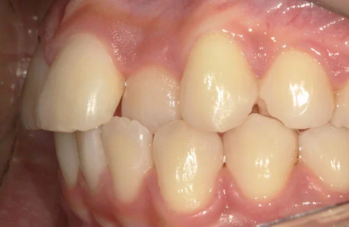 c4-2a | ルーチェマウスピース矯正歯科 治療前右側