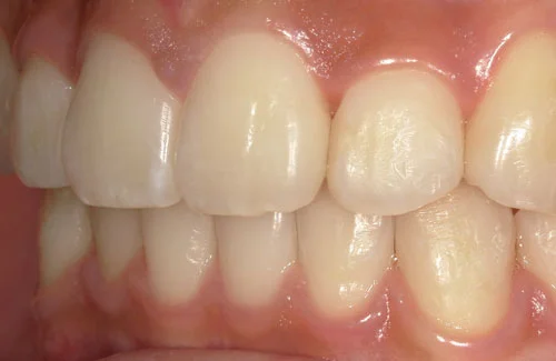 c4-2b | ルーチェマウスピース矯正歯科 治療後右側
