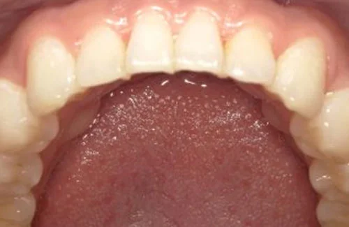 c5-01-01 | ルーチェマウスピース矯正歯科 治療後右側