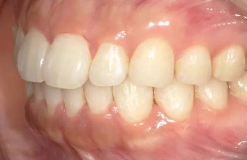 c5-02-01-1 | ルーチェマウスピース矯正歯科 治療後右側