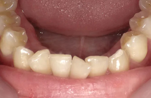 c6-1a | ルーチェマウスピース矯正歯科 治療前右側