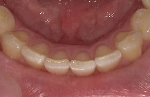 c6-1b | ルーチェマウスピース矯正歯科 治療後右側