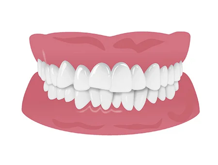 case2 | ルーチェマウスピース矯正歯科 歯並びがデコボコ:叢生(そうせい)