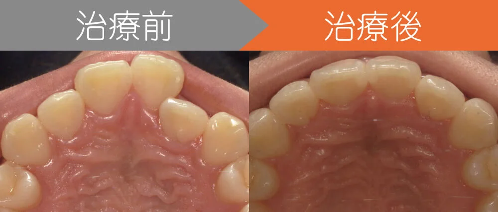 case4-top | ルーチェマウスピース矯正歯科 <症例3>前歯のクロスバイトでお悩み