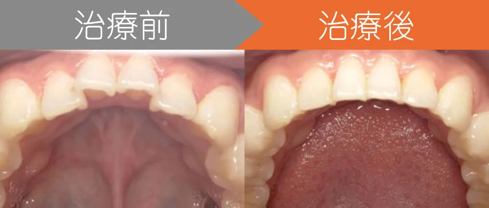 case5-top | ルーチェマウスピース矯正歯科 <症例4>下の前歯がガタガタでお悩み