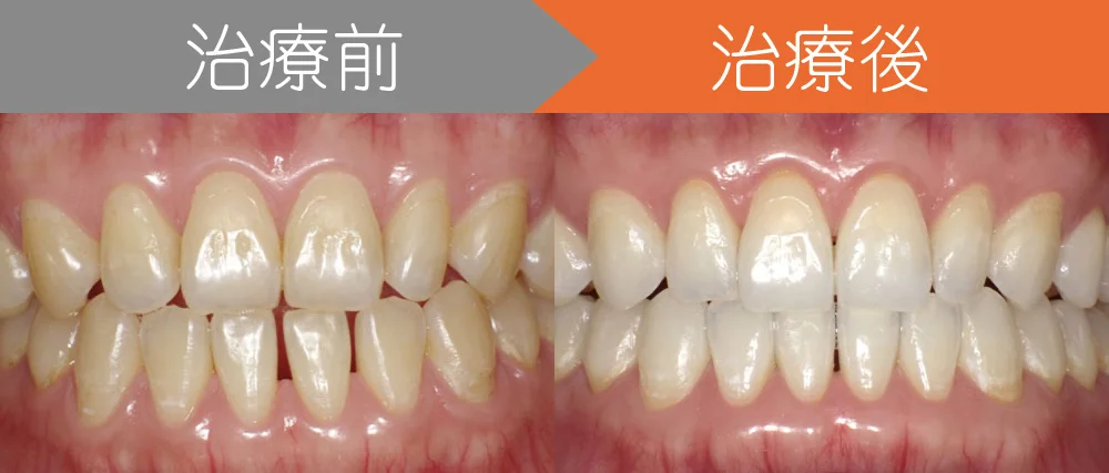 case7-top | ルーチェマウスピース矯正歯科 <症例6>下の前歯が上の前歯よりも前に出ている・しゃくれ・すきっ歯でお悩み