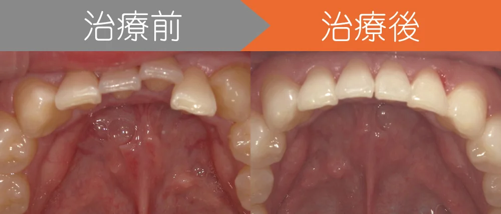 syourei01 | ルーチェマウスピース矯正歯科 <症例1>上下の前歯がガタつき、出っ歯でお悩み