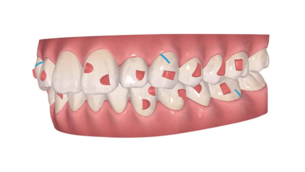attachment-1 | ルーチェマウスピース矯正歯科 アタッチメント