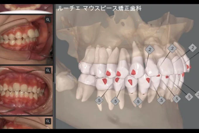 5-cd | ルーチェマウスピース矯正歯科 矯正治療計画のご説明