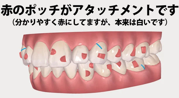 c03-01 | ルーチェマウスピース矯正歯科 インビザライン矯正の歯を動かす仕組みについて