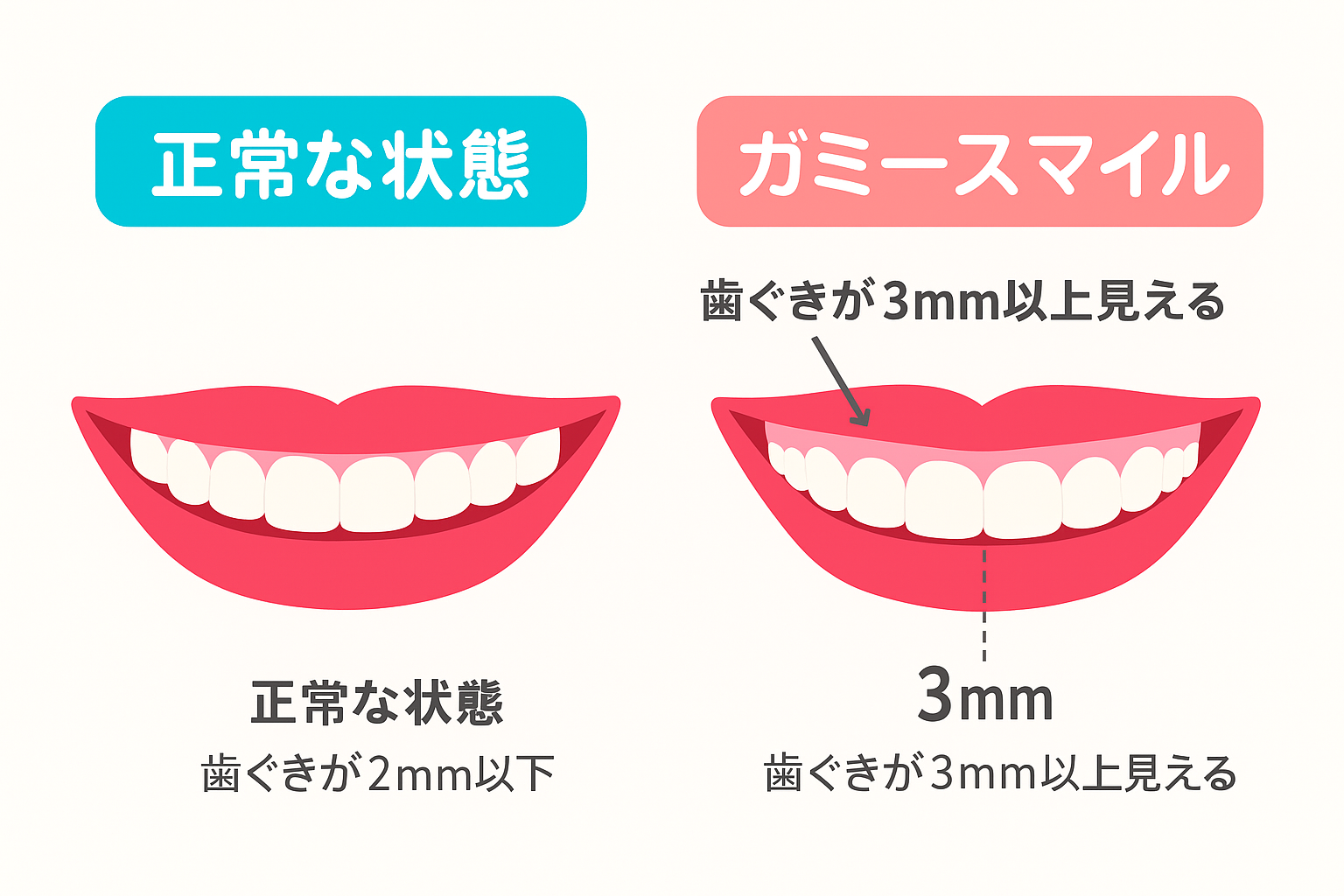 c2f19a49-19e3-4ecd-8e6f-5abbfc33cccc | ルーチェマウスピース矯正歯科 正常な歯肉とガミースマイルの違い
