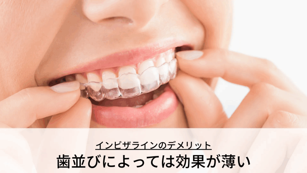 歯並びによっては効果が薄い
