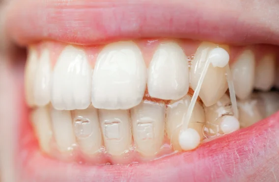 インビザラインのゴムかけとは