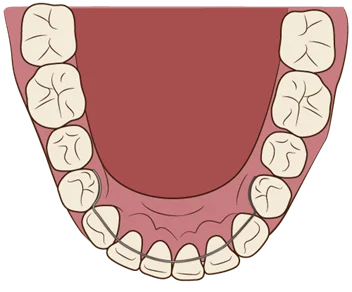 image | ルーチェマウスピース矯正歯科 固定式のリテーナー