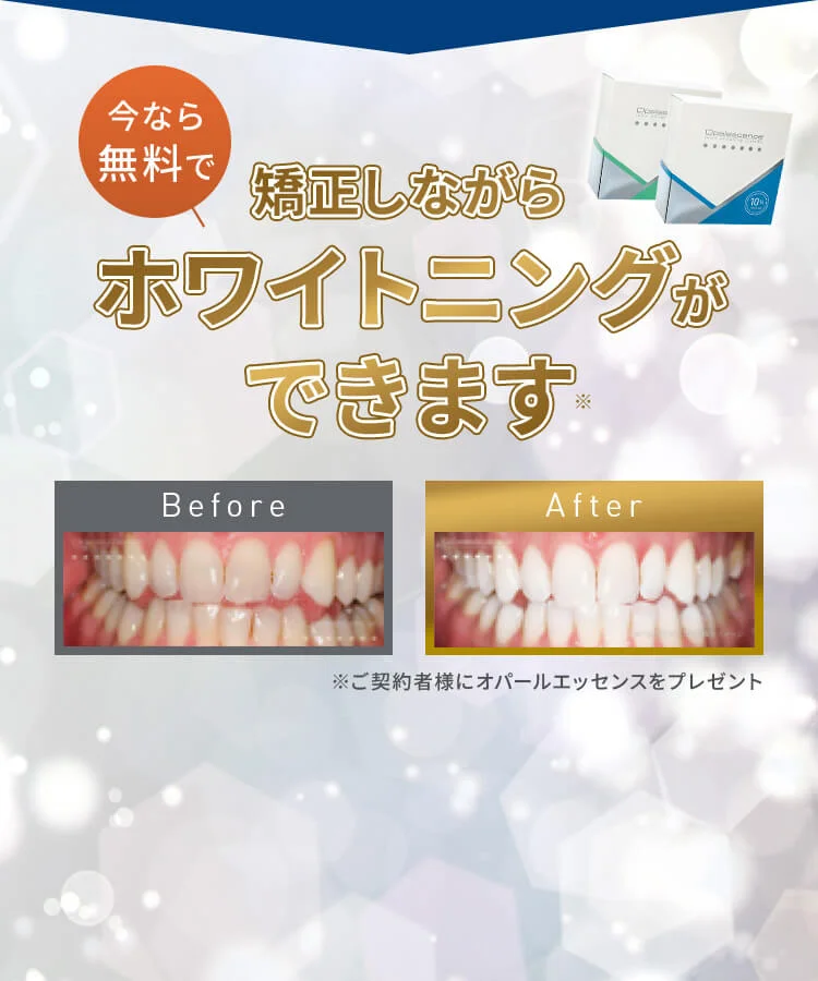 image | ルーチェマウスピース矯正歯科 ホワイトニングができます