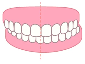 image | ルーチェマウスピース矯正歯科 交叉咬合(こうさこうごう)