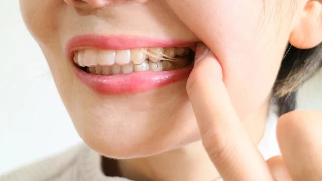 image | ルーチェマウスピース矯正歯科 ゴムかけのよくある質問