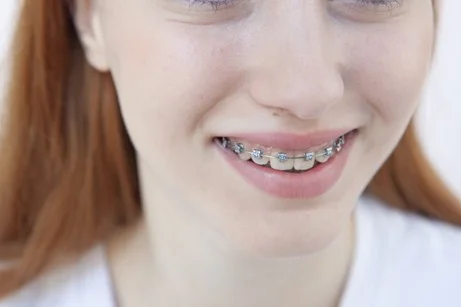 image | ルーチェマウスピース矯正歯科 ワイヤー矯正が向かないケース