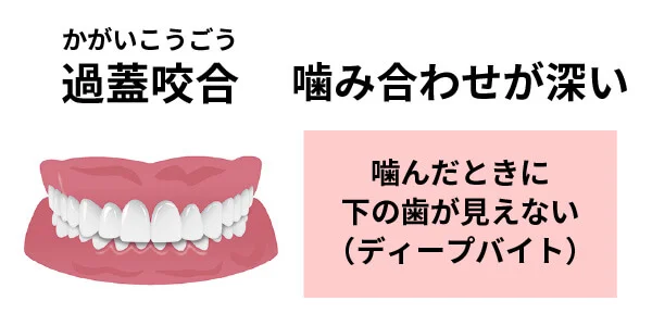 過蓋咬合　説明