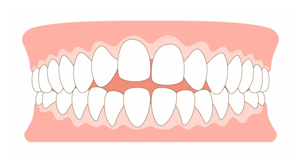| ルーチェマウスピース矯正歯科 開咬 イメージ画像