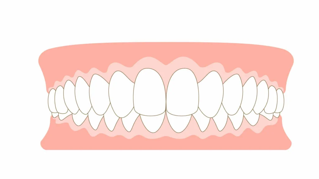 マウスピース矯正の種類-35-1024x576 | ルーチェマウスピース矯正歯科 過蓋咬合